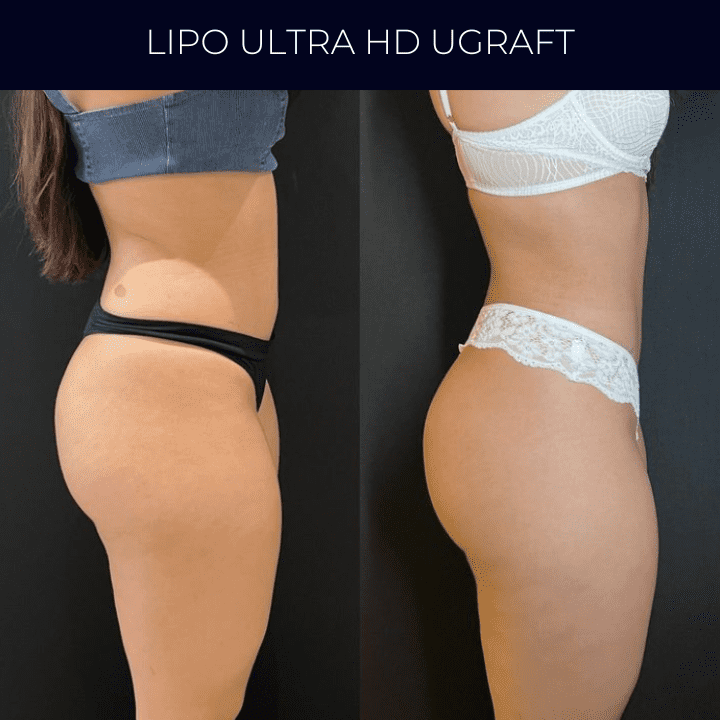 Dr Raul Mendes Martins | Cirurgião Plástico em Curitiba | Lipoaspiração HD Ugraft, Renuvion, Abdominoplastia, Rinoplastia Ultrassônica e Cirurgia Mamária