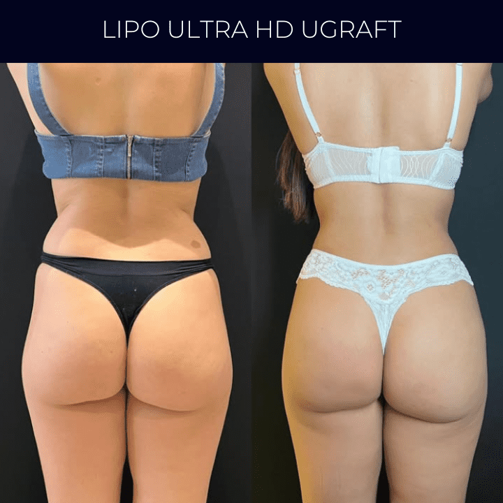 Dr Raul Mendes Martins | Cirurgião Plástico em Curitiba | Lipoaspiração HD Ugraft, Renuvion, Abdominoplastia, Rinoplastia Ultrassônica e Cirurgia Mamária