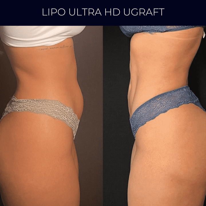 Dr Raul Mendes Martins | Cirurgião Plástico em Curitiba | Lipoaspiração HD Ugraft, Renuvion, Abdominoplastia, Rinoplastia Ultrassônica e Cirurgia Mamária