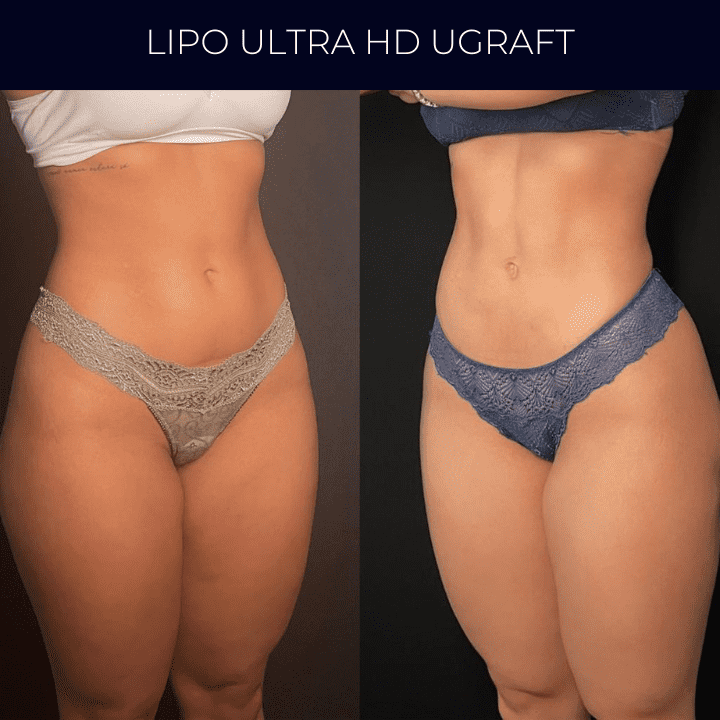Dr Raul Mendes Martins | Cirurgião Plástico em Curitiba | Lipoaspiração HD Ugraft, Renuvion, Abdominoplastia, Rinoplastia Ultrassônica e Cirurgia Mamária