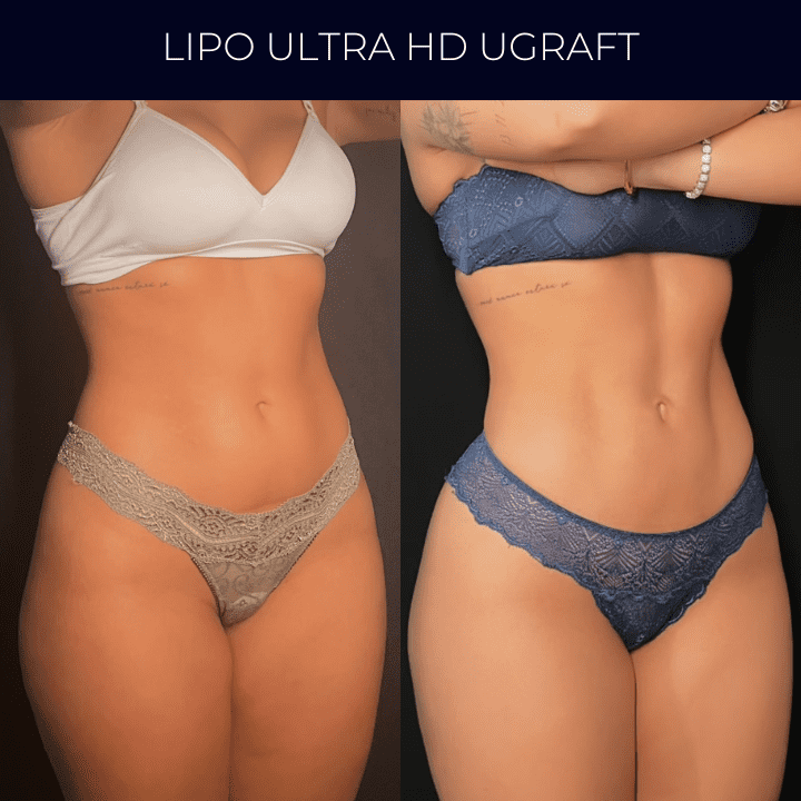 Dr Raul Mendes Martins | Cirurgião Plástico em Curitiba | Lipoaspiração HD Ugraft, Renuvion, Abdominoplastia, Rinoplastia Ultrassônica e Cirurgia Mamária