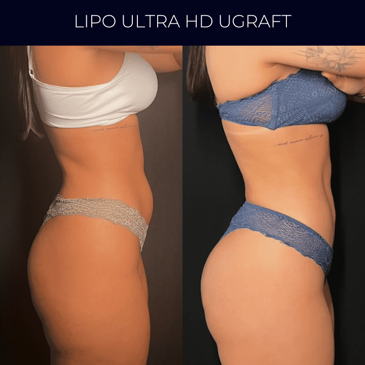 Dr Raul Mendes Martins | Cirurgião Plástico em Curitiba | Lipoaspiração HD Ugraft, Renuvion, Abdominoplastia, Rinoplastia Ultrassônica e Cirurgia Mamária