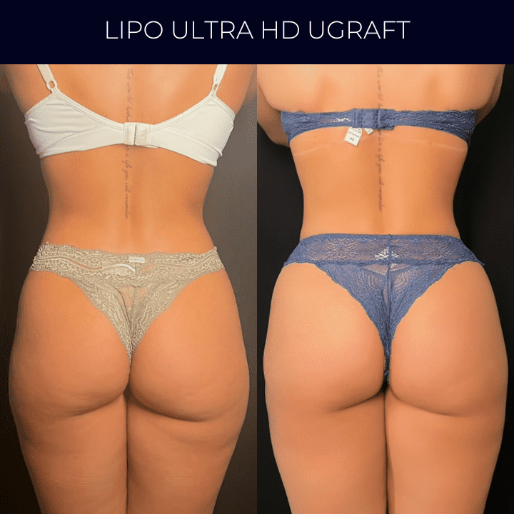 Dr Raul Mendes Martins | Cirurgião Plástico em Curitiba | Lipoaspiração HD Ugraft, Renuvion, Abdominoplastia, Rinoplastia Ultrassônica e Cirurgia Mamária