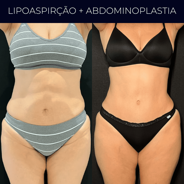 Dr Raul Mendes Martins | Cirurgião Plástico em Curitiba | Lipoaspiração HD Ugraft, Renuvion, Abdominoplastia, Rinoplastia Ultrassônica e Cirurgia Mamária