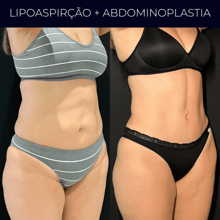 Dr Raul Mendes Martins | Cirurgião Plástico em Curitiba | Lipoaspiração HD Ugraft, Renuvion, Abdominoplastia, Rinoplastia Ultrassônica e Cirurgia Mamária