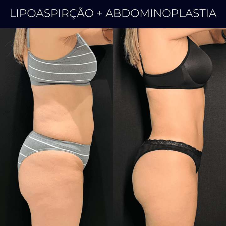 Dr Raul Mendes Martins | Cirurgião Plástico em Curitiba | Lipoaspiração HD Ugraft, Renuvion, Abdominoplastia, Rinoplastia Ultrassônica e Cirurgia Mamária