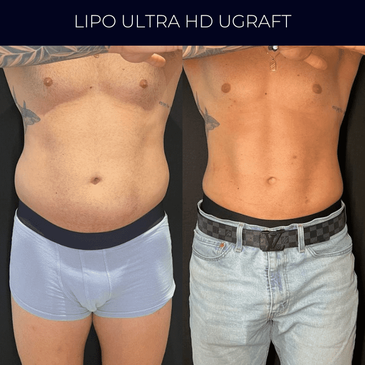 Dr Raul Mendes Martins | Cirurgião Plástico em Curitiba | Lipoaspiração HD Ugraft, Renuvion, Abdominoplastia, Rinoplastia Ultrassônica e Cirurgia Mamária