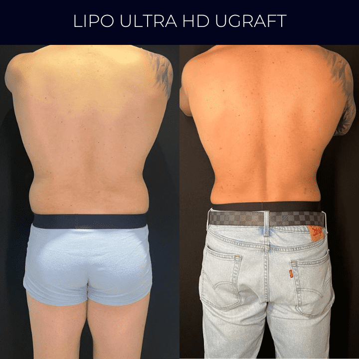 Dr Raul Mendes Martins | Cirurgião Plástico em Curitiba | Lipoaspiração HD Ugraft, Renuvion, Abdominoplastia, Rinoplastia Ultrassônica e Cirurgia Mamária