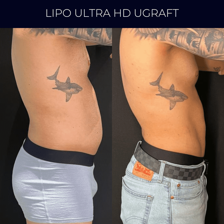 Dr Raul Mendes Martins | Cirurgião Plástico em Curitiba | Lipoaspiração HD Ugraft, Renuvion, Abdominoplastia, Rinoplastia Ultrassônica e Cirurgia Mamária