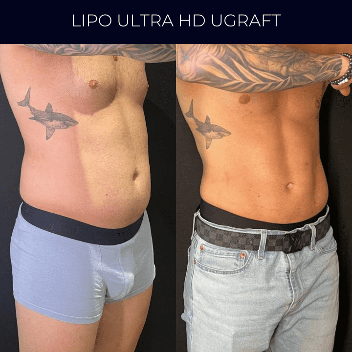 Dr Raul Mendes Martins | Cirurgião Plástico em Curitiba | Lipoaspiração HD Ugraft, Renuvion, Abdominoplastia, Rinoplastia Ultrassônica e Cirurgia Mamária