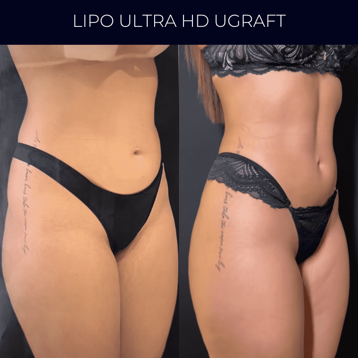 Dr Raul Mendes Martins | Cirurgião Plástico em Curitiba | Lipoaspiração HD Ugraft, Renuvion, Abdominoplastia, Rinoplastia Ultrassônica e Cirurgia Mamária