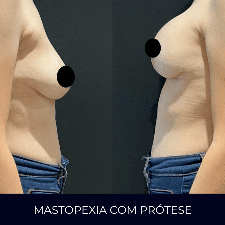Dr Raul Mendes Martins | Cirurgião Plástico em Curitiba | Lipoaspiração HD Ugraft, Renuvion, Abdominoplastia, Rinoplastia Ultrassônica e Cirurgia Mamária