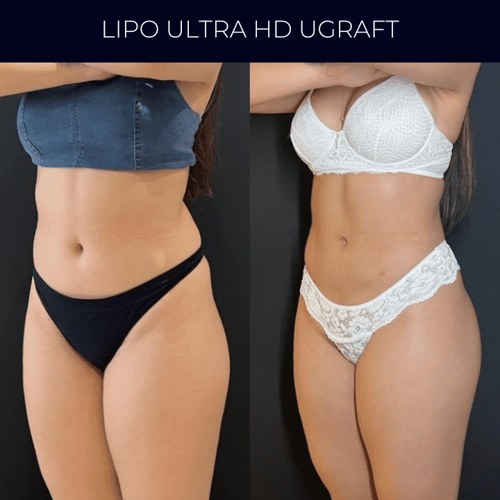 Dr Raul Mendes Martins | Cirurgião Plástico em Curitiba | Lipoaspiração HD Ugraft, Renuvion, Abdominoplastia, Rinoplastia Ultrassônica e Cirurgia Mamária
