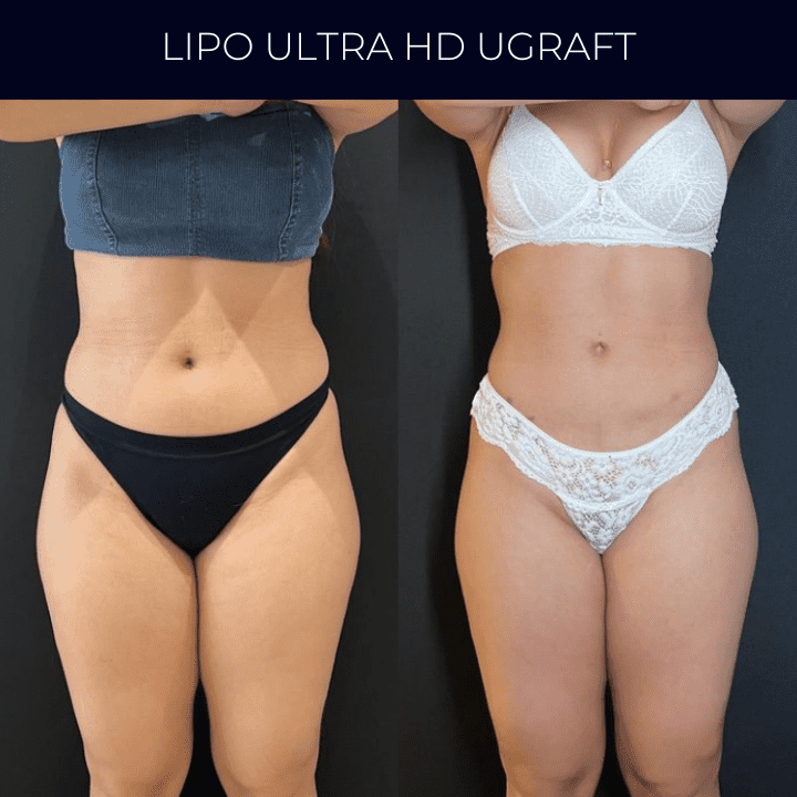 Dr Raul Mendes Martins | Cirurgião Plástico em Curitiba | Lipoaspiração HD Ugraft, Renuvion, Abdominoplastia, Rinoplastia Ultrassônica e Cirurgia Mamária